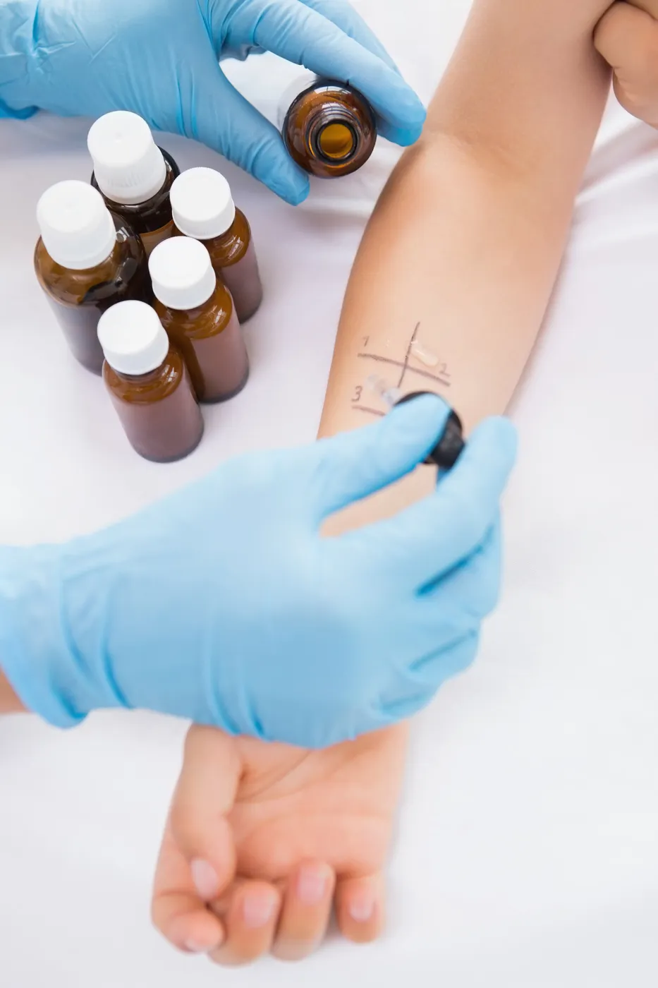 Lékař provádí pacientovi kožní alergologický test